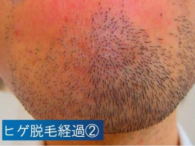 ヒゲ脱毛経過2