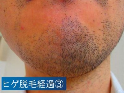 ヒゲ脱毛経過3