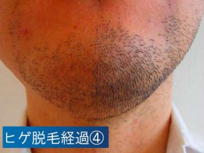 ヒゲ脱毛経過4