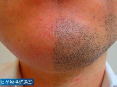 ヒゲ脱毛経過5